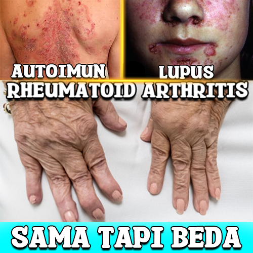 Autoimun Lupus Rheumatoid Arthritis Sama Tapi Beda