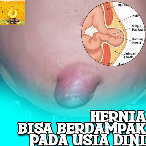 Hernia pada Anak: Mengenali Tanda, Gejala, dan Solusi yang Tepat