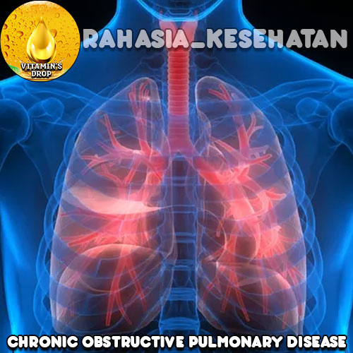 Chronic Obstructive Pulmonary Disease (COPD) Bronkitis Kronis