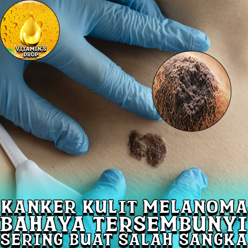 Kanker Kulit Melanoma Bahaya yang Perlu Anda Ketahui