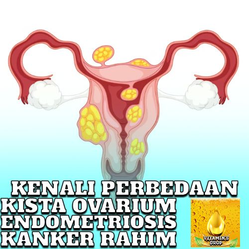 Kista ovarium, endometriosis, dan kanker rahim