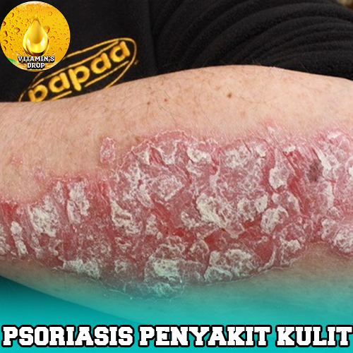 Psoriasis Penyakit Kulit yang Aneh dan Langka