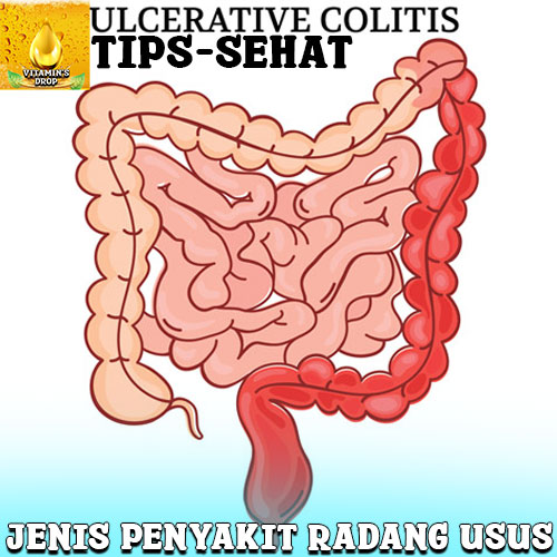 Ulcerative Colitis Jangan Dianggap Remeh, Bisa Berakhir Fatal