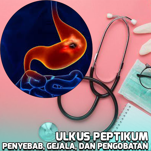 Ulkus Peptikum Memahami Penyebab, Gejala, dan Pengobatan