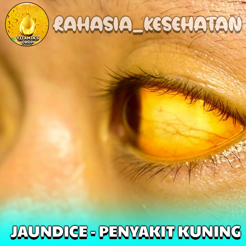 Jaundice – Penyakit Kuning, Penyebab, Gejala, dan Pengobatannya