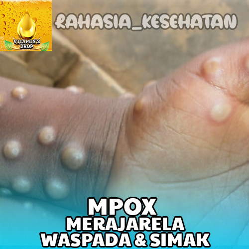 MPOX Merajarela Akankah Menjadi Pandemi Global?