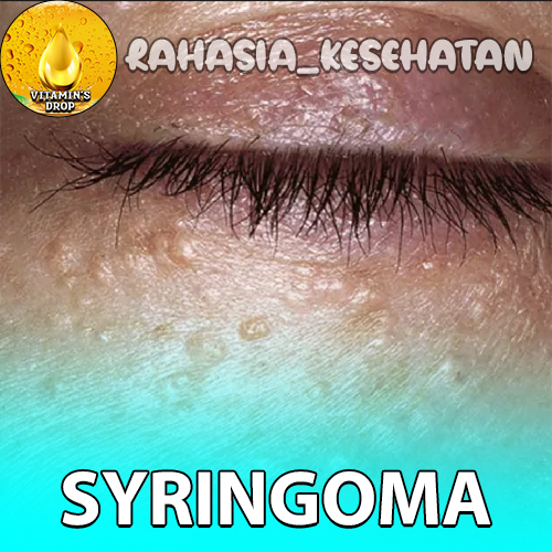 Syringoma Gejala yang Harus Diperhatikan