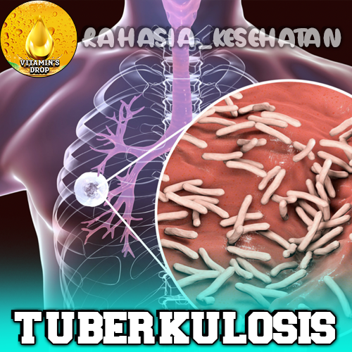 Tuberkulosis Pencegahan Sejak Usia Dini untuk Masa Depan