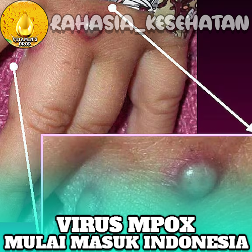 Virus Mpox Mengganas Mulai Masuk Indonesia