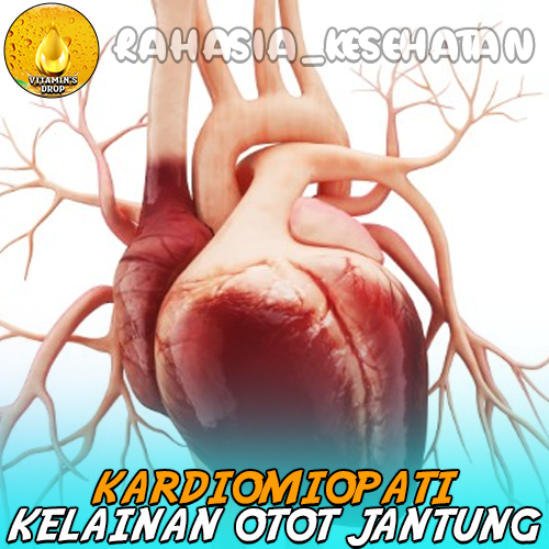 Kardiomiopati Kelainan Otot Jantung yang Perlu Anda Kenali