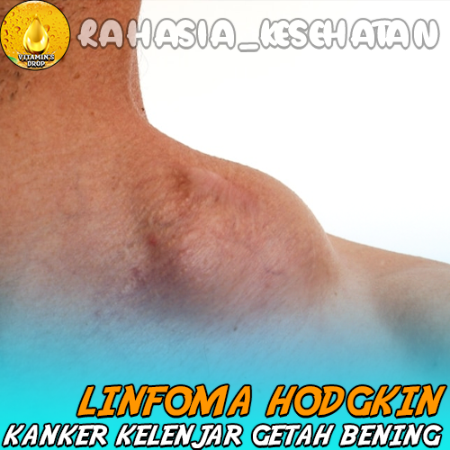 Linfoma Hodgkin Memahami Kanker Kelenjar Getah Bening