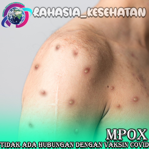 Mpox Tidak Ada Hubungan dengan Vaksin COVID