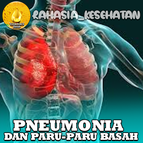 Pneumonia dan Paru-Paru Basah Apakah Sama? Simak!