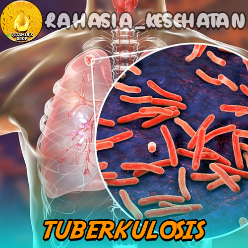 Tuberkulosis Kenali Dampak dan Solusinya