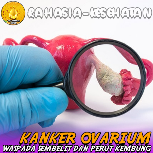 Kanker Ovarium Waspada Sembelit dan Perut Kembung