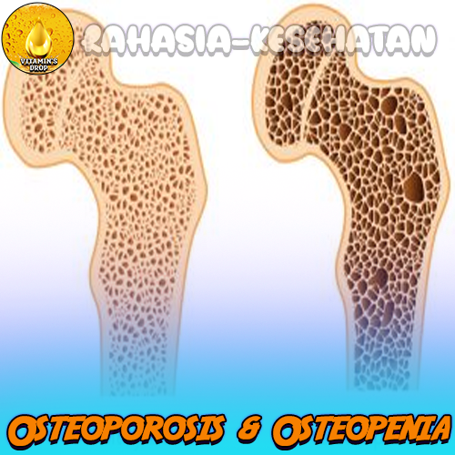 Osteoporosis & Osteopenia Kenali Perbedaannya