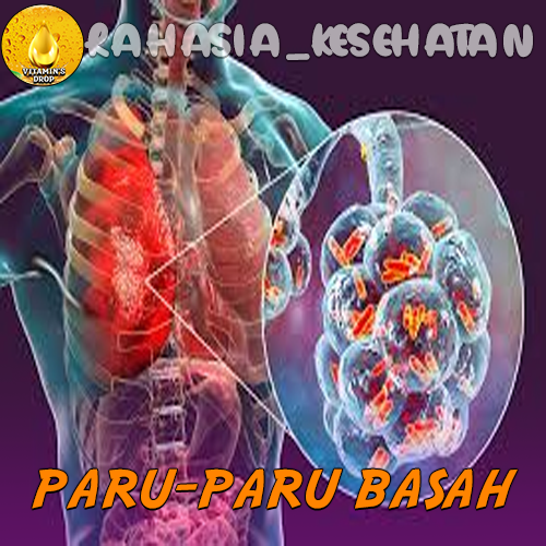 Paru-Paru Basah Kenali Tanda dan Gejalanya