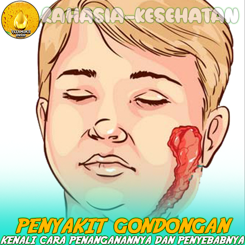 Penyakit Gondongan Simak Penjelasannya