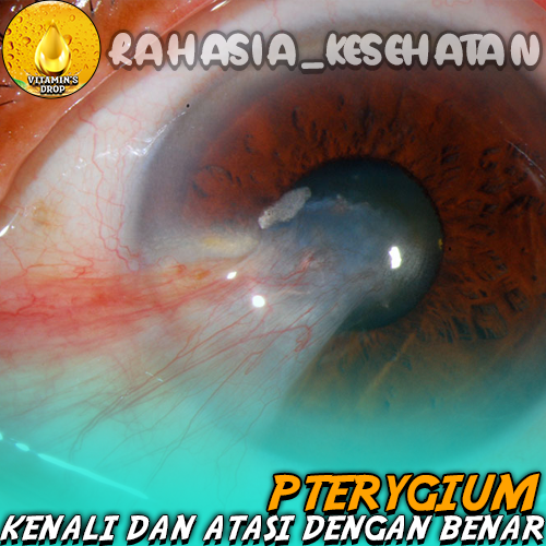 Pterygium Kenali dan Atasi dengan Benar