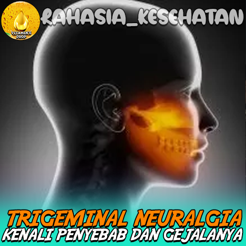 Trigeminal Neuralgia Kenali Penyebab dan Gejalanya