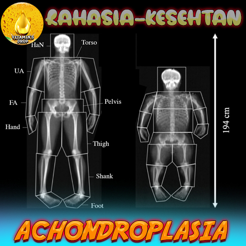 Achondroplasia: Kenali dan Pahami Lebih Lanjut