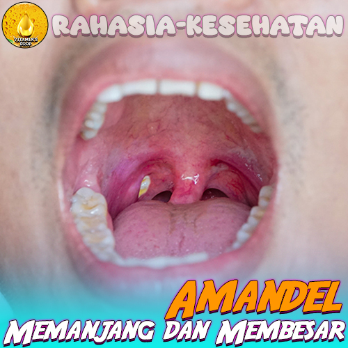 Amandel Memanjang dan Membesar Saat Bangun Tidur? Simak!