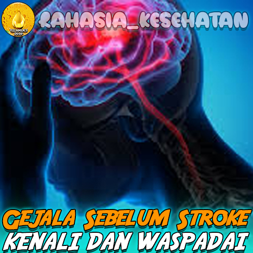 Gejala Sebelum Stroke Menyerang Ayo Simak!