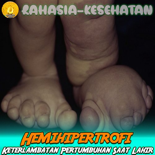 Hemihipertrofi (Hemihyperplasia) Keterlambatan Pertumbuhan Saat Lahir