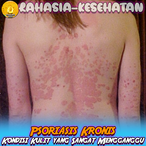 Psoriasis Kronis Kondisi Kulit yang Sangat Mengganggu