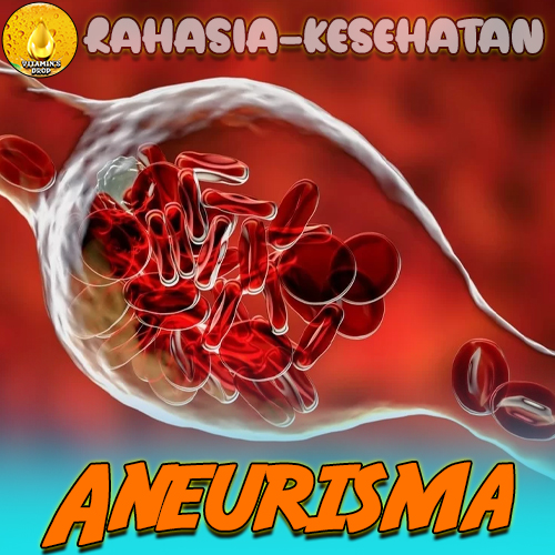 Aneurisma: Kenali dan Simak Lebih Lanjut