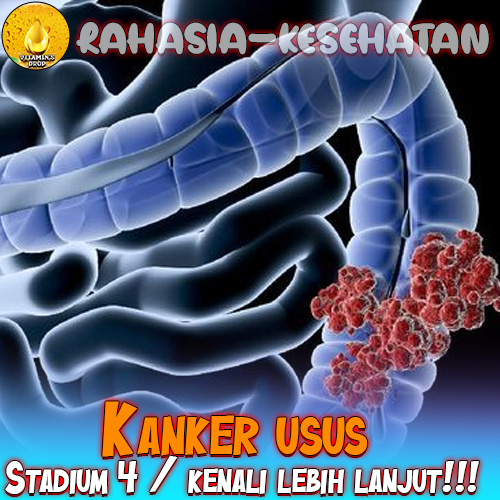 Kanker usus – trending seorang pria usia 23 thn  stadium 4