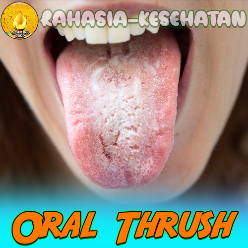 Oral Thrush (Lidah Berjamur): Kenali Penyebabn