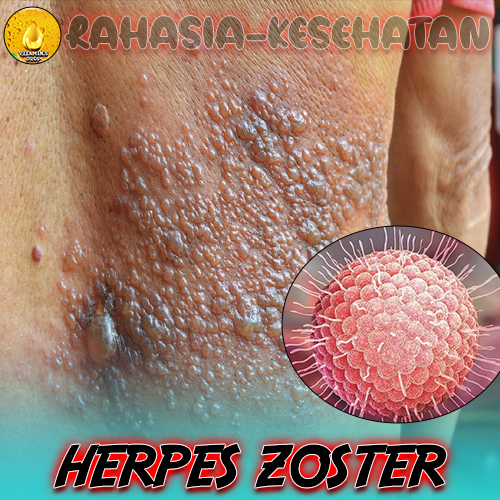 Bahaya Herpes Zoster pada Pasien Komorbid