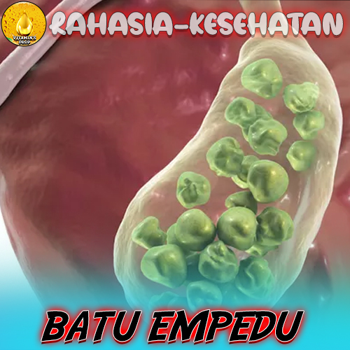 Waspada Batu Empedu: Kenali dan Pahami Gejalanya