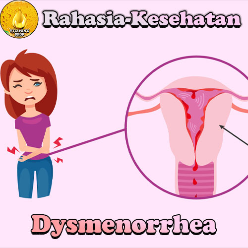 Dysmenorrhea Kenali Lebih Lanjut (nyeri haid)