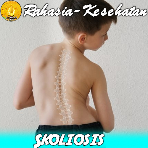 Skoliosis: Pahami Kondisi dan Gejalanya Sebelum Terlambat