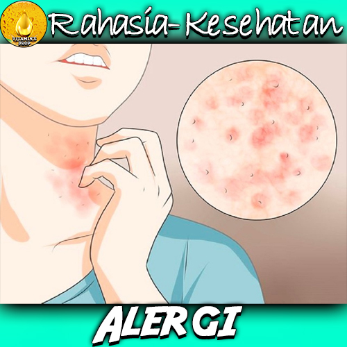 Alergi – Sebenarnya Apa dan Penyebabnya Gimana, Sih?