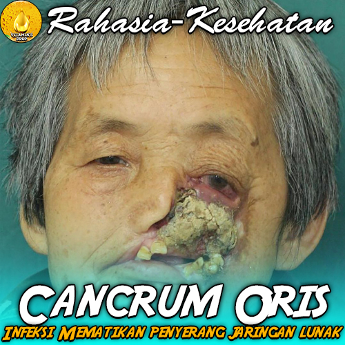 Cancrum Oris: Infeksi Langka yang Mengancam Nyawa Anak-anak