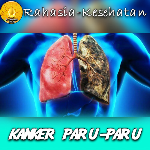 Kanker Paru-Paru: Bengkak pada Wajah hingga Nyeri di Bahu