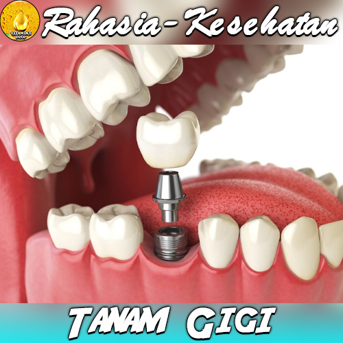 Tanam Gigi – Apakah Ada Dampak Negatif?