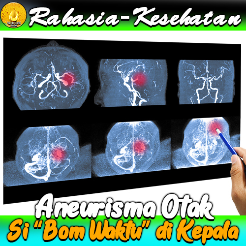 Aneurisma Otak: Si “Bom Waktu” di Kepala Sering Tak Di Sadari