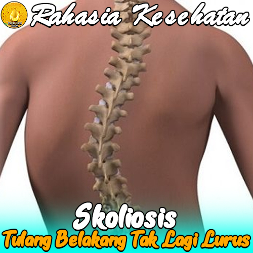 Skoliosis Ketika Tulang Belakang Tak Lagi Lurus