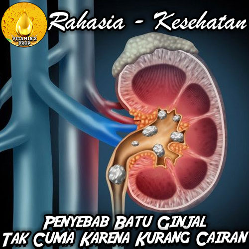 Penyebab Batu Ginjal yang Jarang Diketahui: Tak Cuma Karena Kurang Cairan