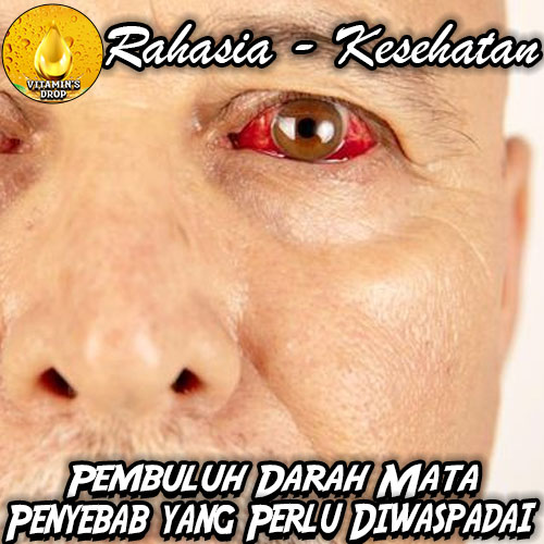Penyebab Pecah Pembuluh Darah Mata yang Perlu Diwaspadai