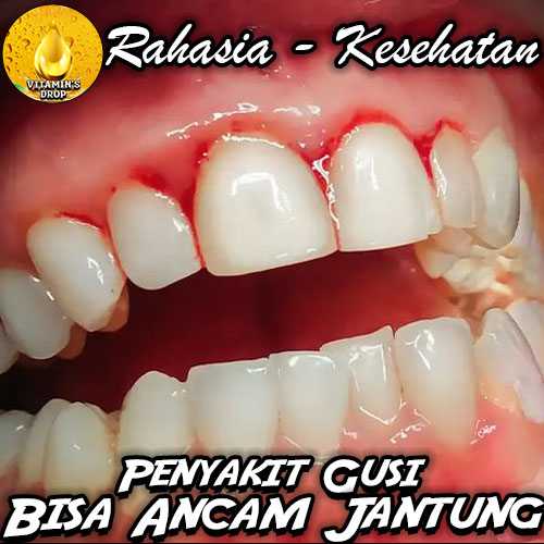 Penyakit Gusi Bisa Ancam Jantung: Waspadai Hubungan yang Sering Diabaikan